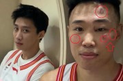 触目惊心！打了一场CBA比赛，整张脸都被“毁容”了 球迷：可怕